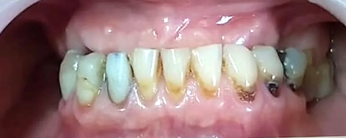 Antes: arco inferior con los dientes desgastados, oscurecidos y con restauraciones antiguas.