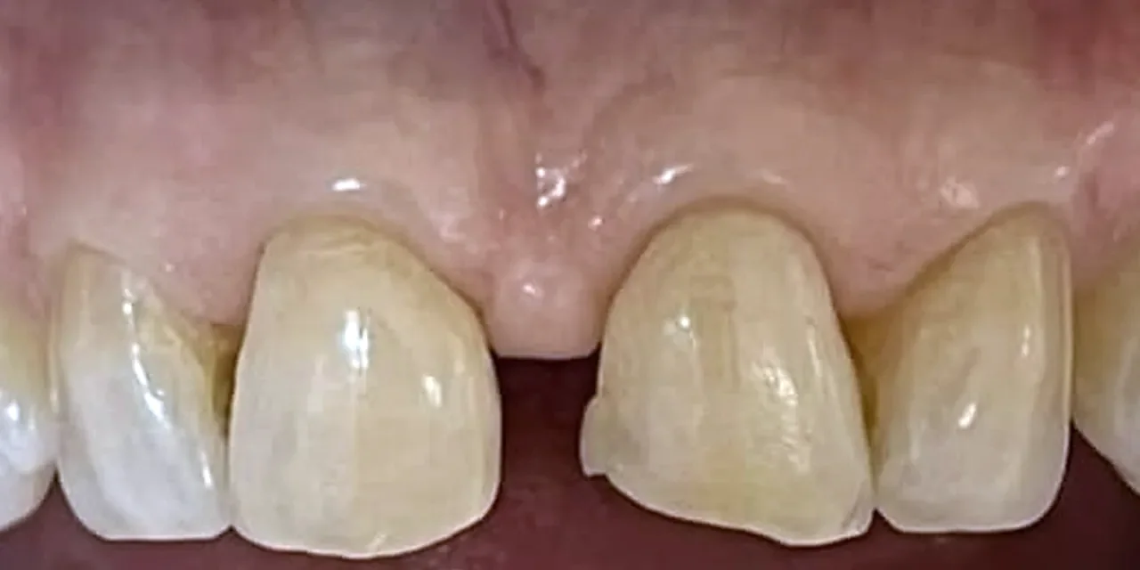 Antes: los dos incisivos centrales desgastados, con el diastema entre ellos.