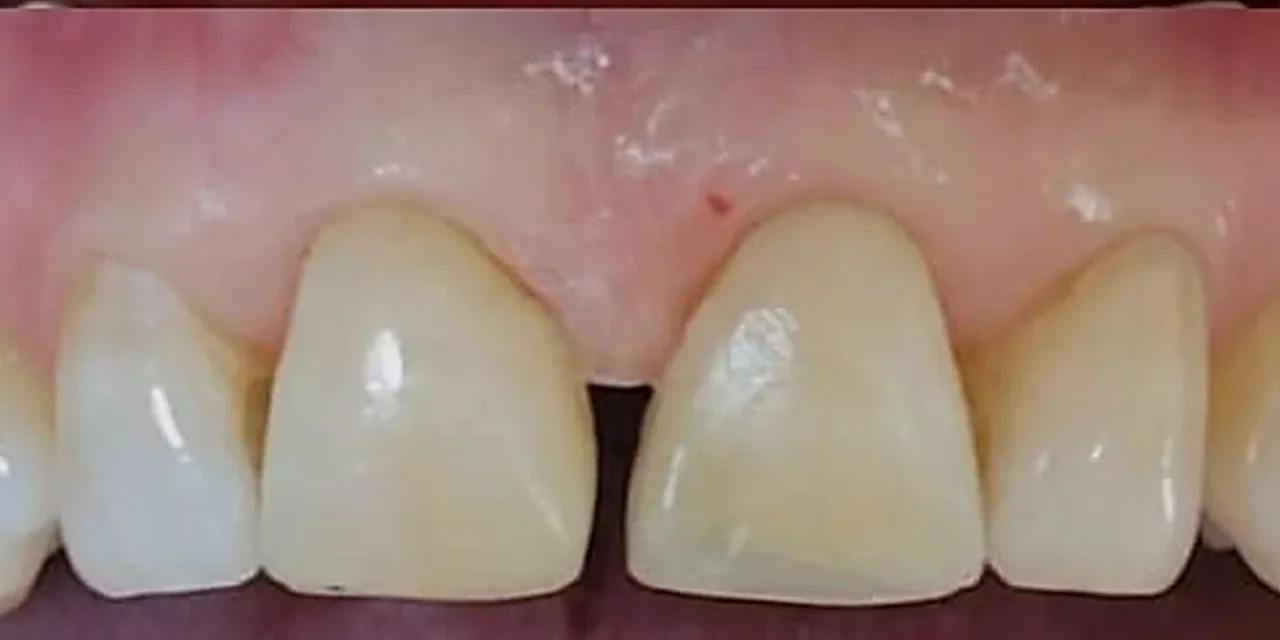 Después: los mismos incisivos reconstruidos con resina compuesta, fotografiados con el mismo encuadre y conservando el diastema de la paciente.