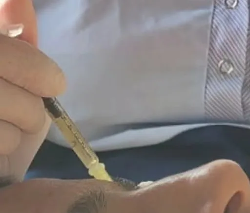 Aplicación de plasma rico en plaquetas con microaguja en el rostro de un paciente.